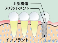 「歯科インプラント」とは？