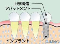  歯科インプラント　歯を失った方の治療法