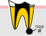 虫歯なのに痛みがない