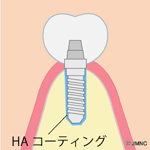 HAインプラント