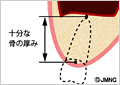 骨を増やす治療と手術時間