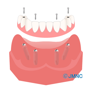 【オールオン4】多くの歯を失った方、入れ歯の方におすすめの治療法