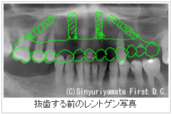 インプラント治療計画