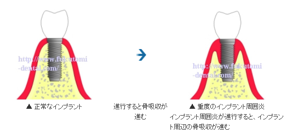 ある日インプラントが抜けた！？インプラント歯周炎予防に定期