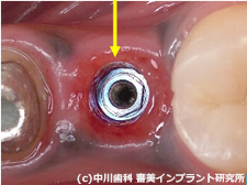 症例写真　インプラント手術後2ヶ月