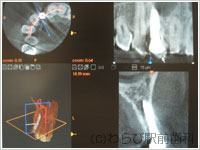 前歯を1本失った場合の症例 （3Dシミュレーションソフトの利用）