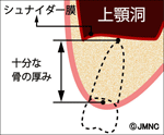 上あごの歯の断面