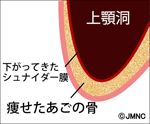 痩せたあごの骨