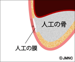 歯茎を縫合する