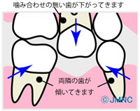 歯科治療で補綴が必要な理由