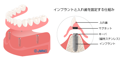 入れ歯を磁石で固定するインプラント治療