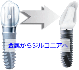 金属からジルコニアへ