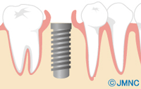 STEP4　インプラントを埋め込む
