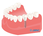 インプラント治療の場合