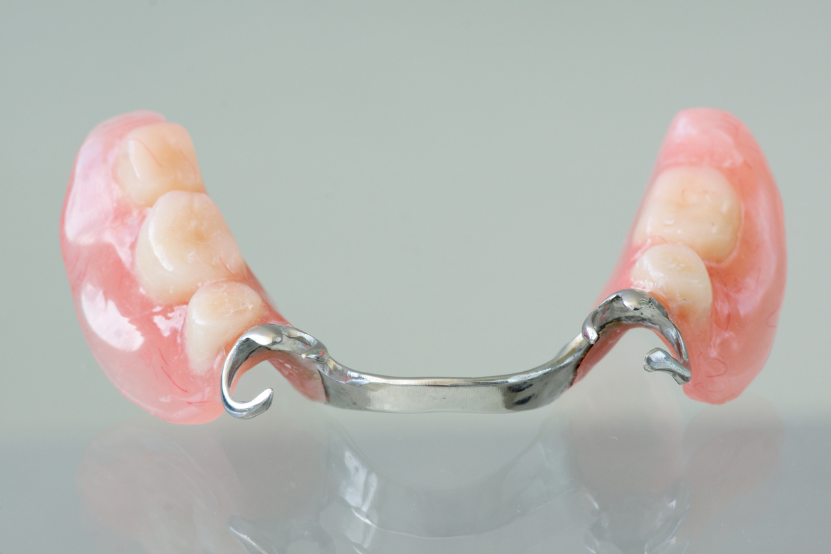 入れ歯 部分 一番奥の歯1本だけを入れ歯にすることは可能ですか？