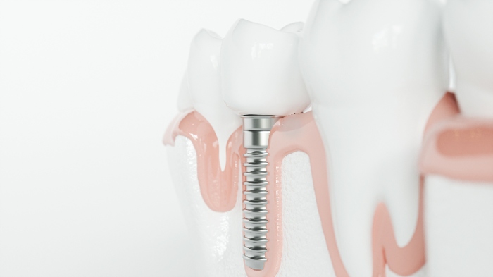 歯周病でもインプラントはできる？ インプラントと歯周病の関係