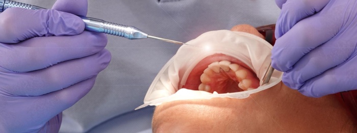 歯周組織再生療法の手術中