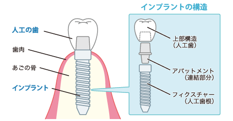 インプラントの構造を理解しよう！