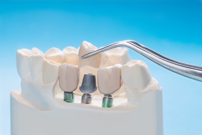 インプラント人工歯のイメージ模型