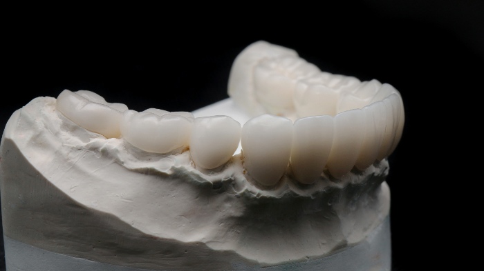 抜けてしまった歯の両隣に残っている歯を土台にする延長ブリッジ