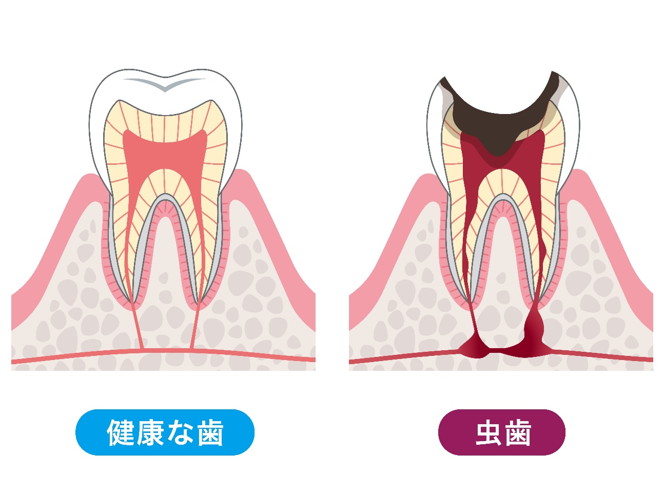 健康な歯と虫歯が神経まで侵食してしまっている状態を比較