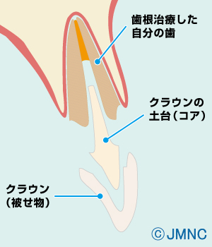 差し歯はどんな構造?