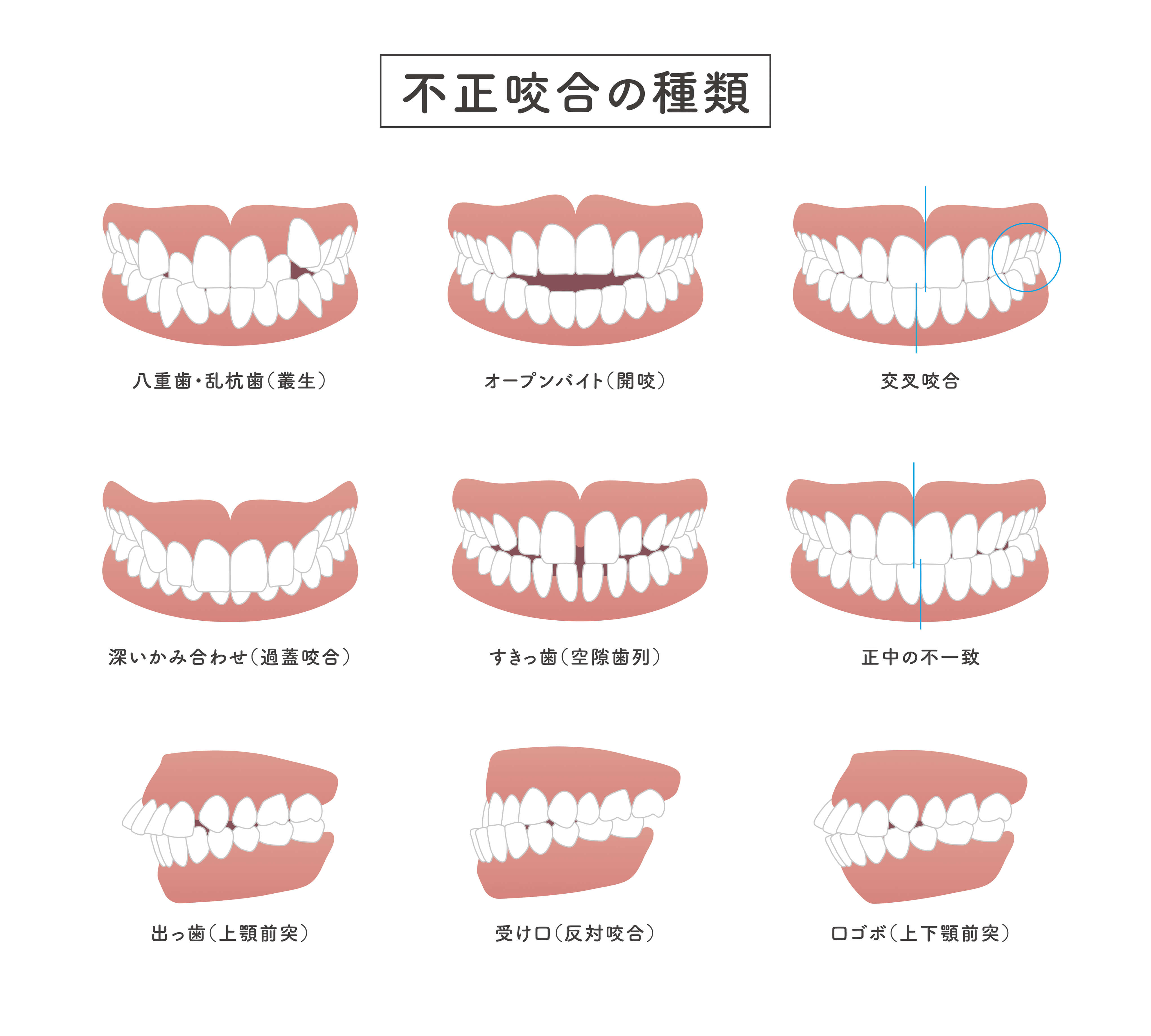 噛み合わせの悪さ