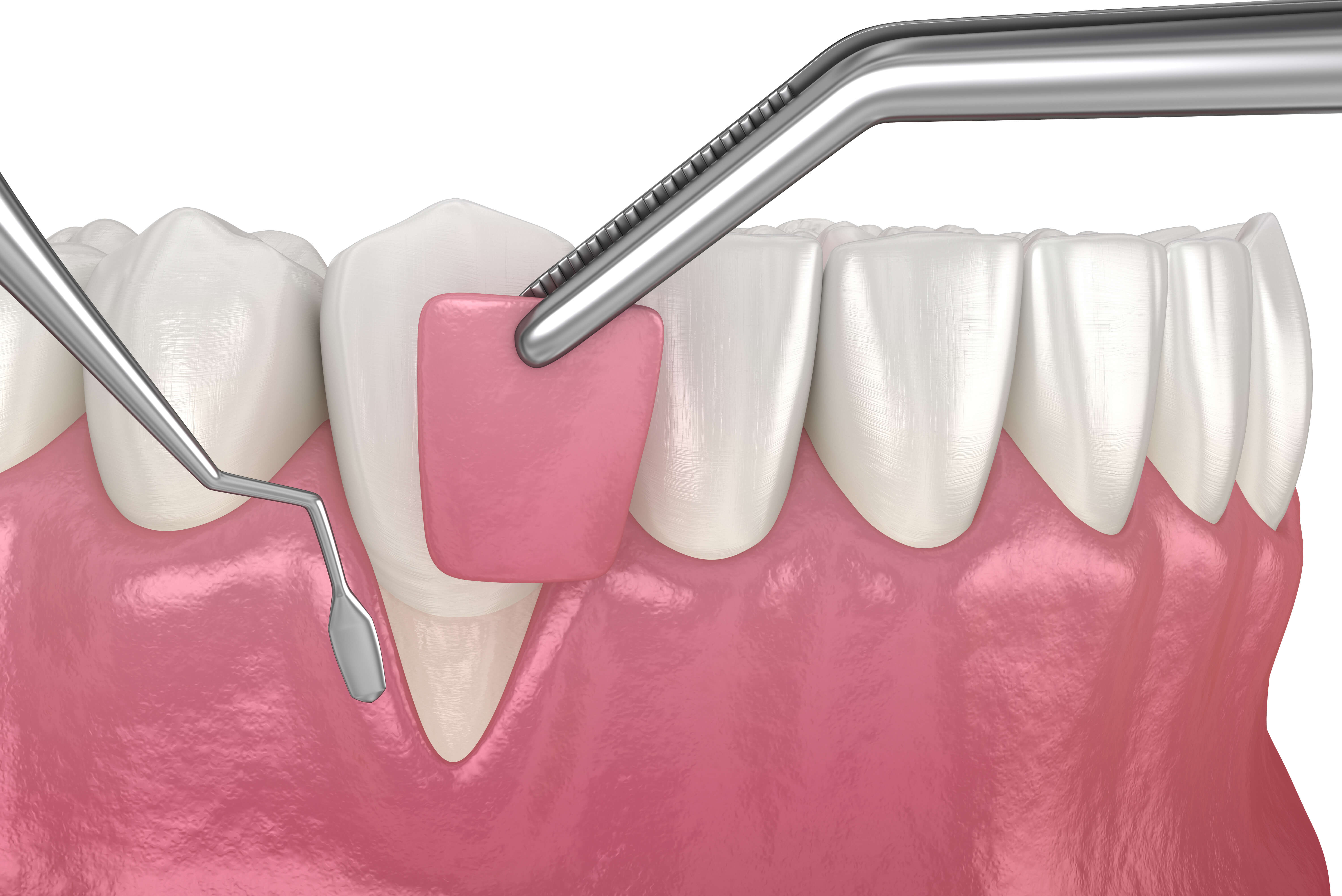 下がった歯茎を治す「歯肉再生」療法とは