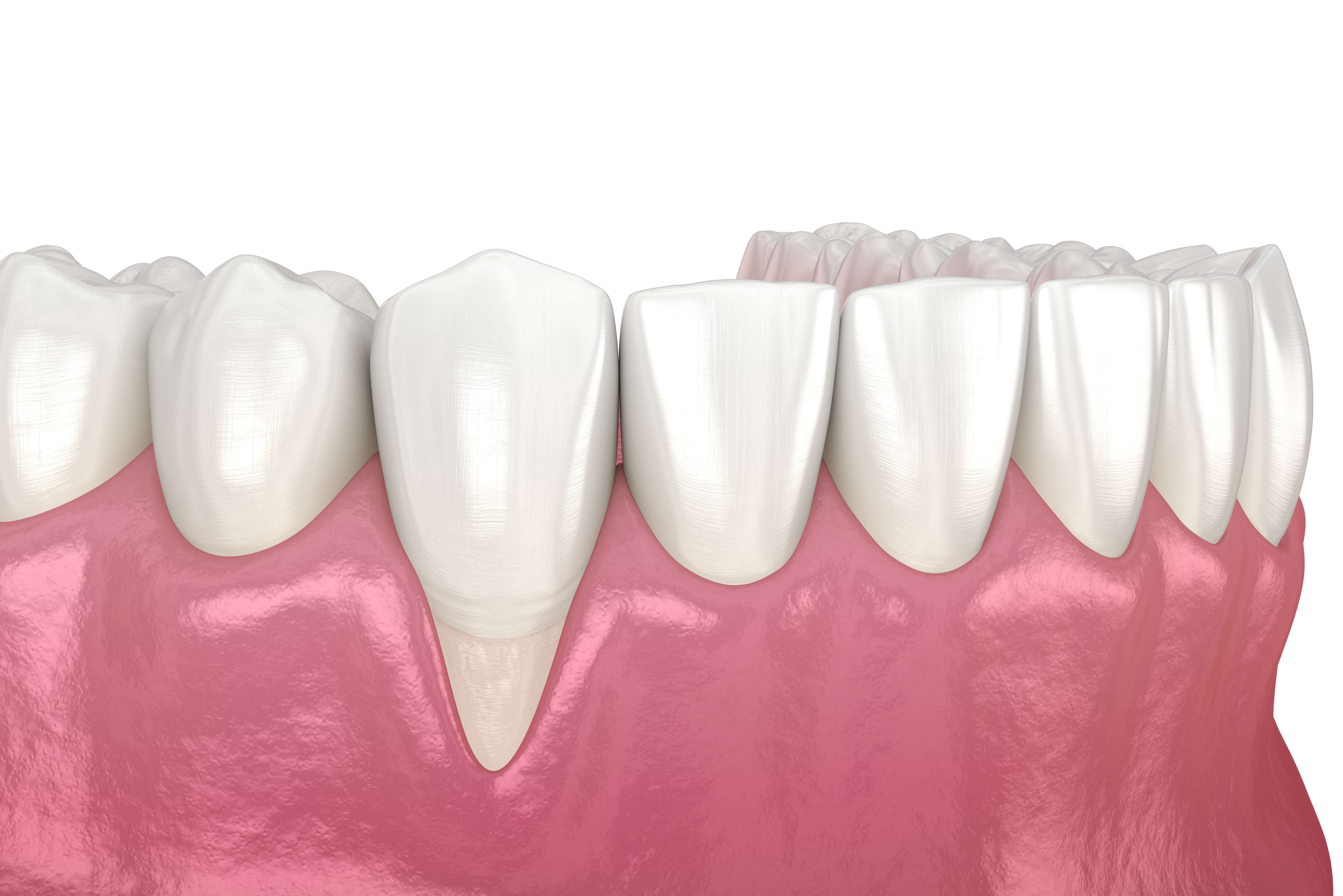 インプラントと歯肉再生 抜歯で下がった歯茎は治る？