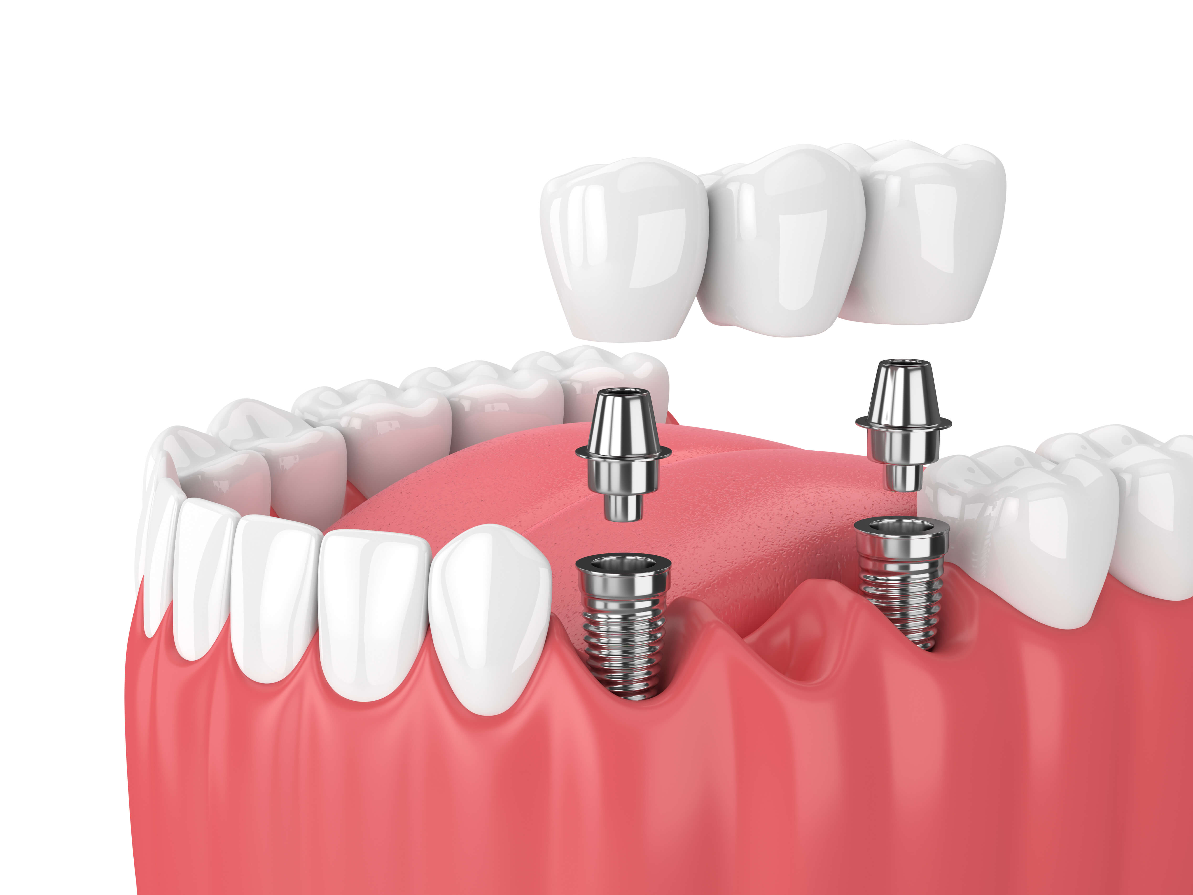 インプラントとご自身の歯を併用してブリッジ治療を選択することもできる