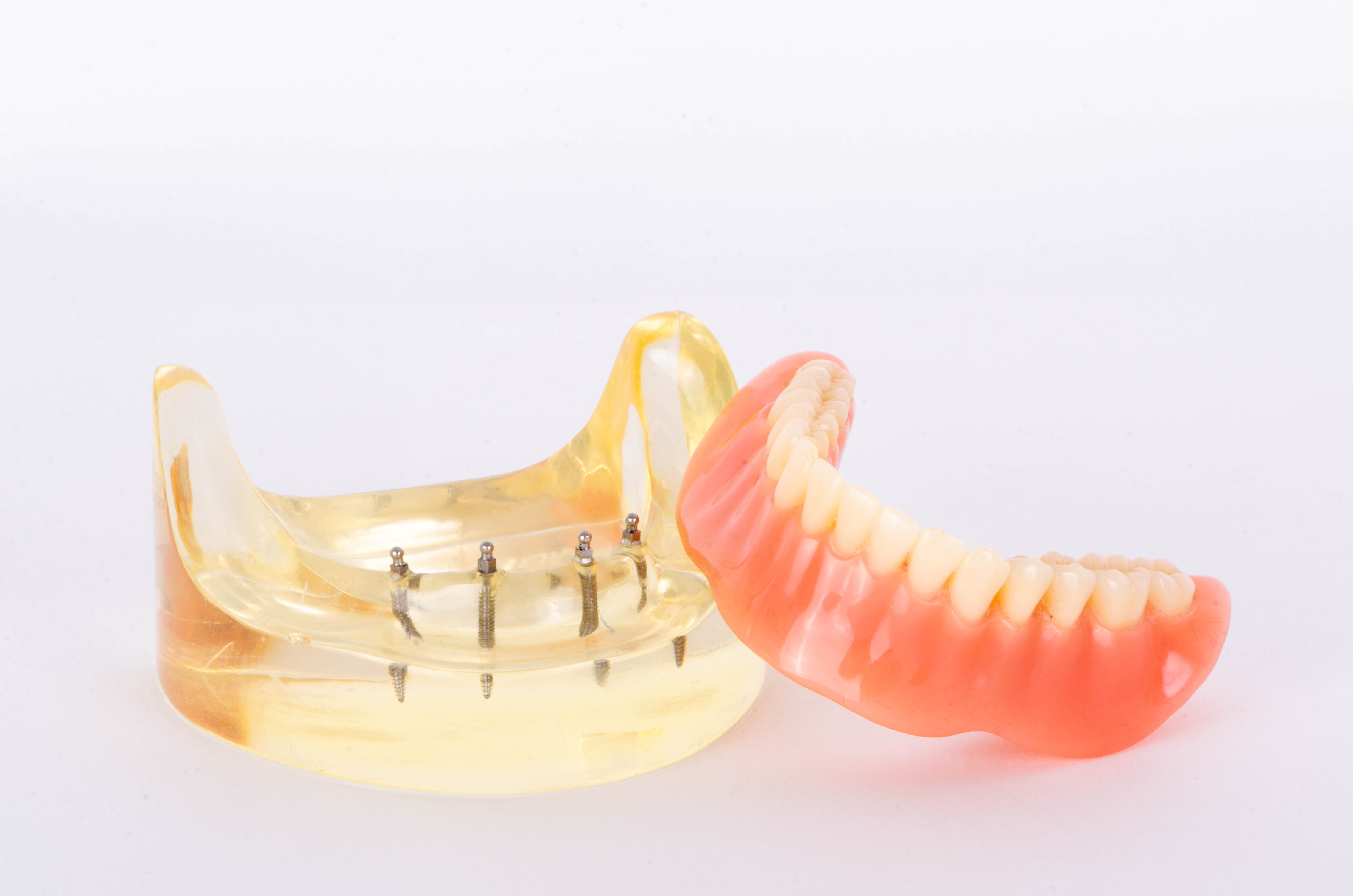 入れ歯　インプラント　治療期間比較