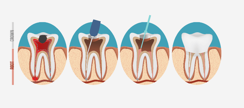 根管治療　歯の壊死