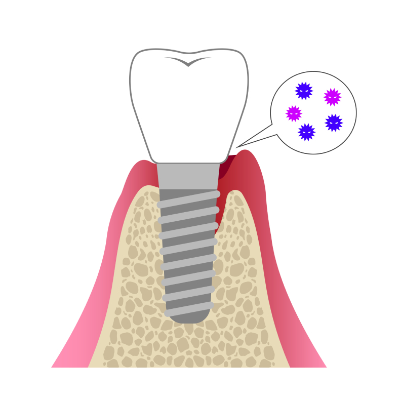 インプラント周囲炎