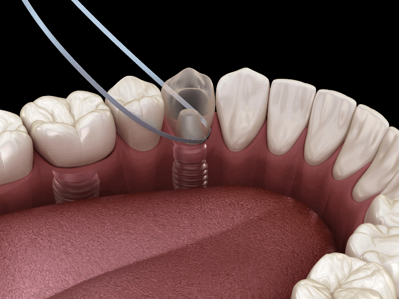インプラントの臭いを解決！ フロスでできる対策と予防法