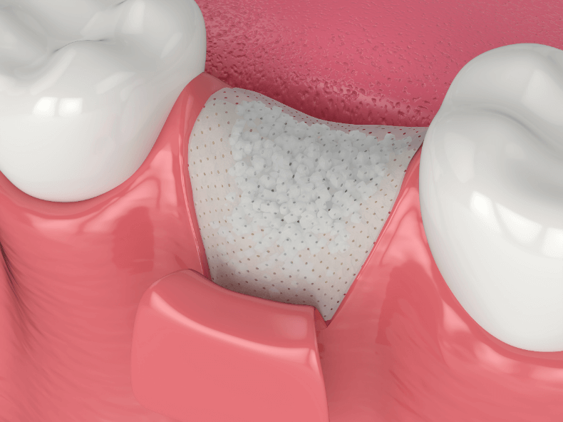歯根嚢胞　インプラント　骨造成