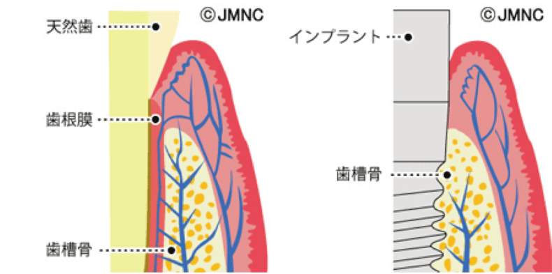 インプラント