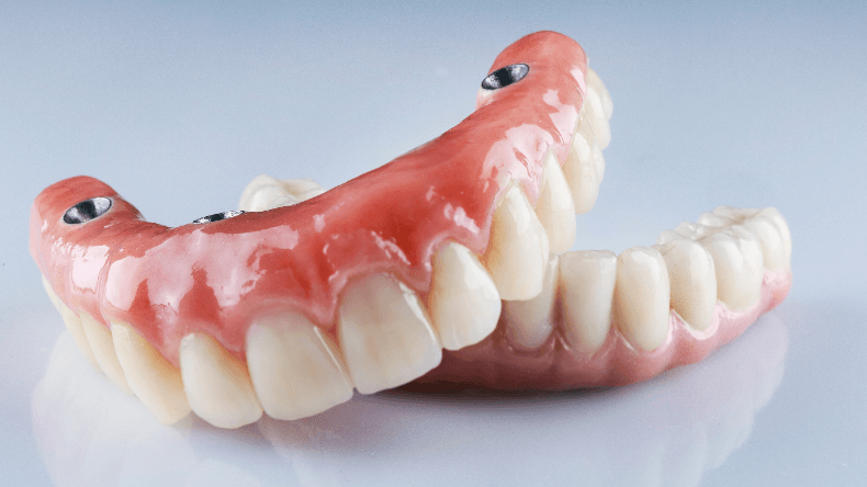 インプラントと天然歯でブリッジをすることは可能？