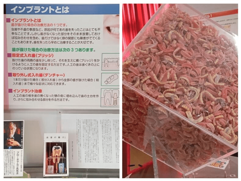 インプラント 歯医者