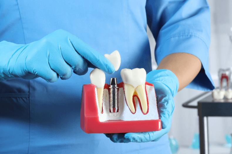 インプラント治療において、歯がない期間は避けられないの？