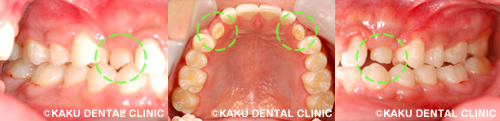 乳歯 インプラント