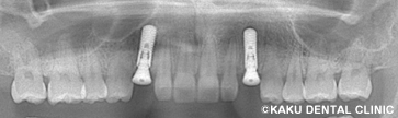 インプラント 乳歯
