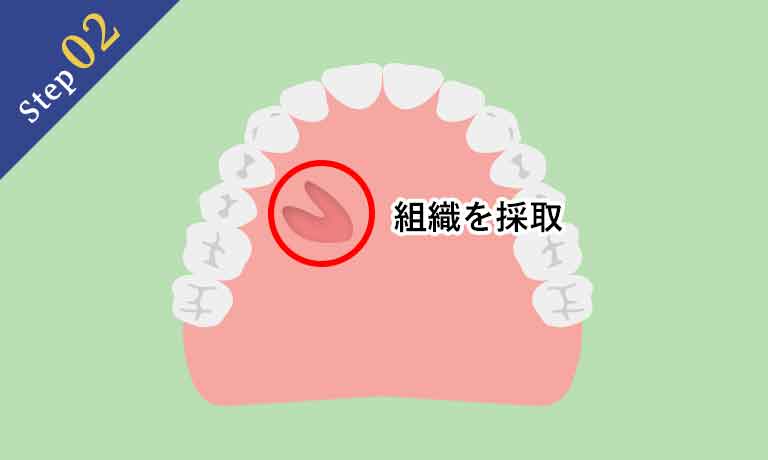 結合組織移植術