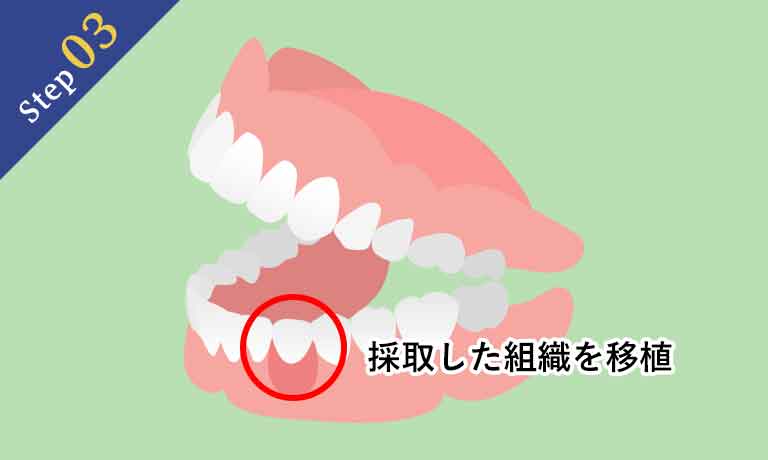 結合組織移植術