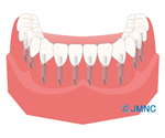 All-on-4（オールオンフォー）を利用しない従来のインプラント治療の場合
