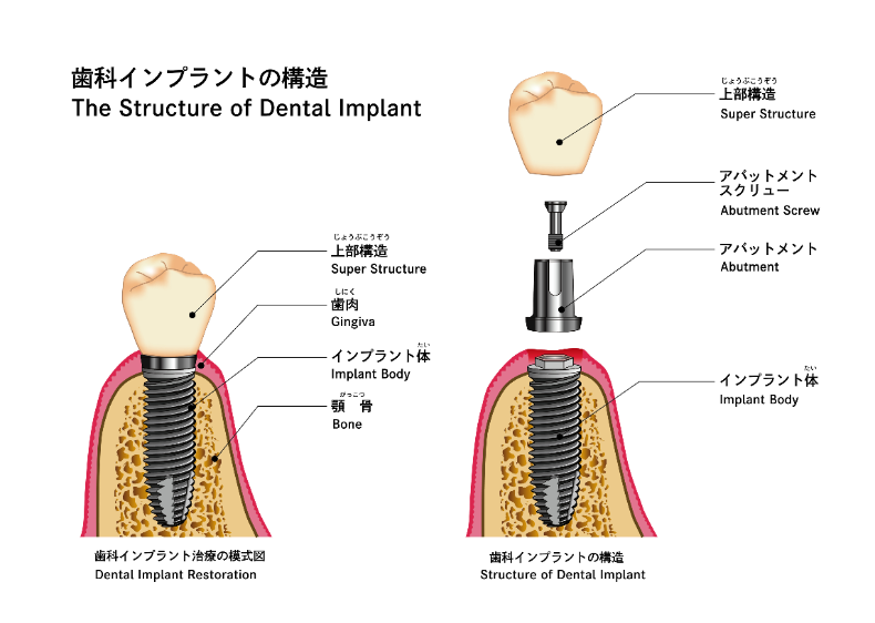 インプラントを4項目で比較！形状、構造、治療法の違いとは？