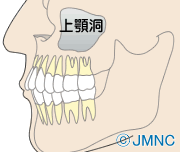 上顎洞炎