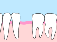 歯を失ったまま放置している方へ