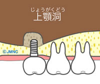 ソケットリフト