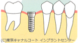 一回法