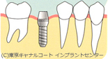 インプラント治療の種類